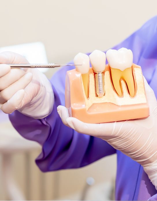Reabilitação com Implantes Orais